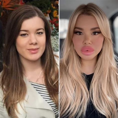 Halle Hayes before and after surgery : r/bimbofication